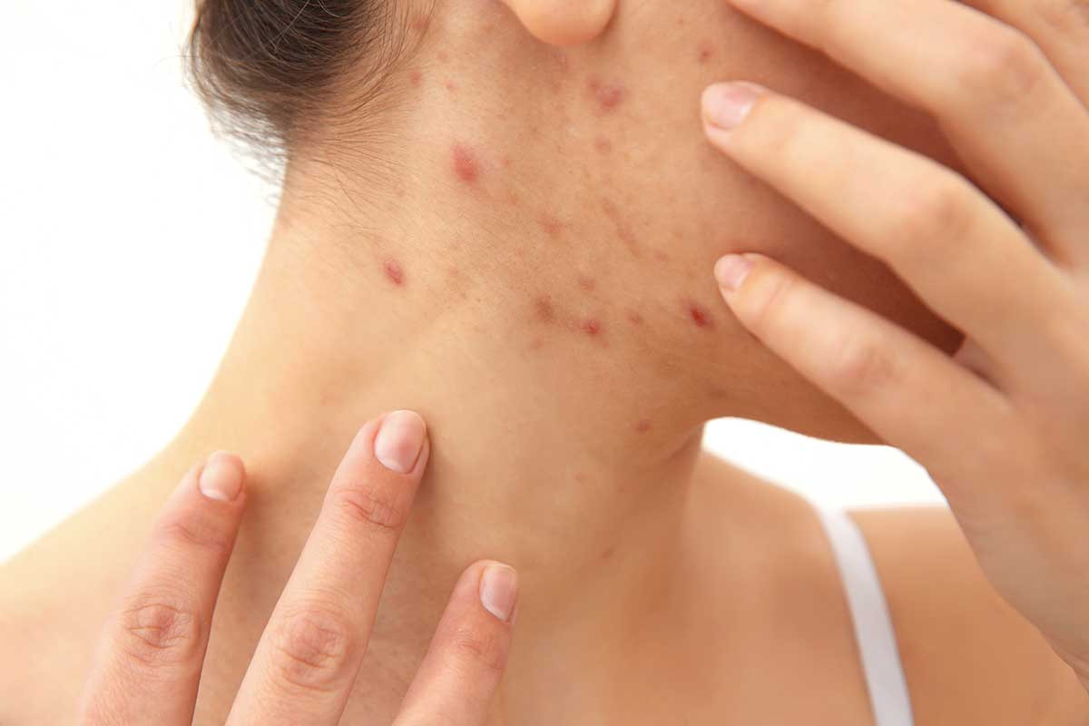 Kožní problémy zaměnitelné s akné